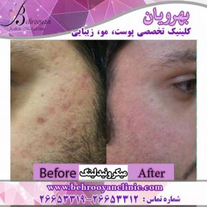 میکرونیدلینگ میکرونیدلینگ