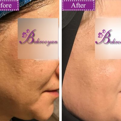 microneedeling جوانسازی پوست با میکرونیدلینگ