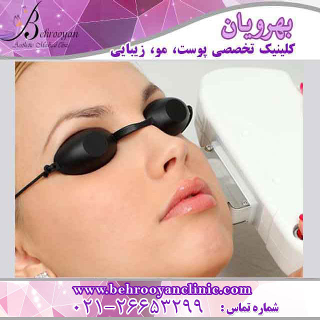 لیزر موی زاید