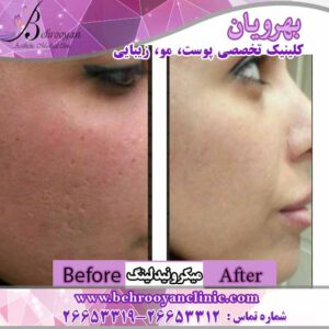 نمونه میکرونیدلینگ نمونه میکرونیدلینگ