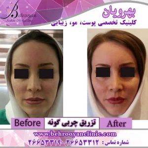 تزریق چربی