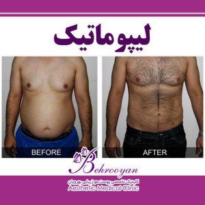 لیپوماتیک