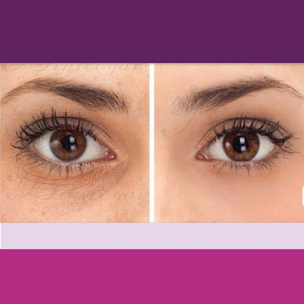 تزریق ژل و فیلر