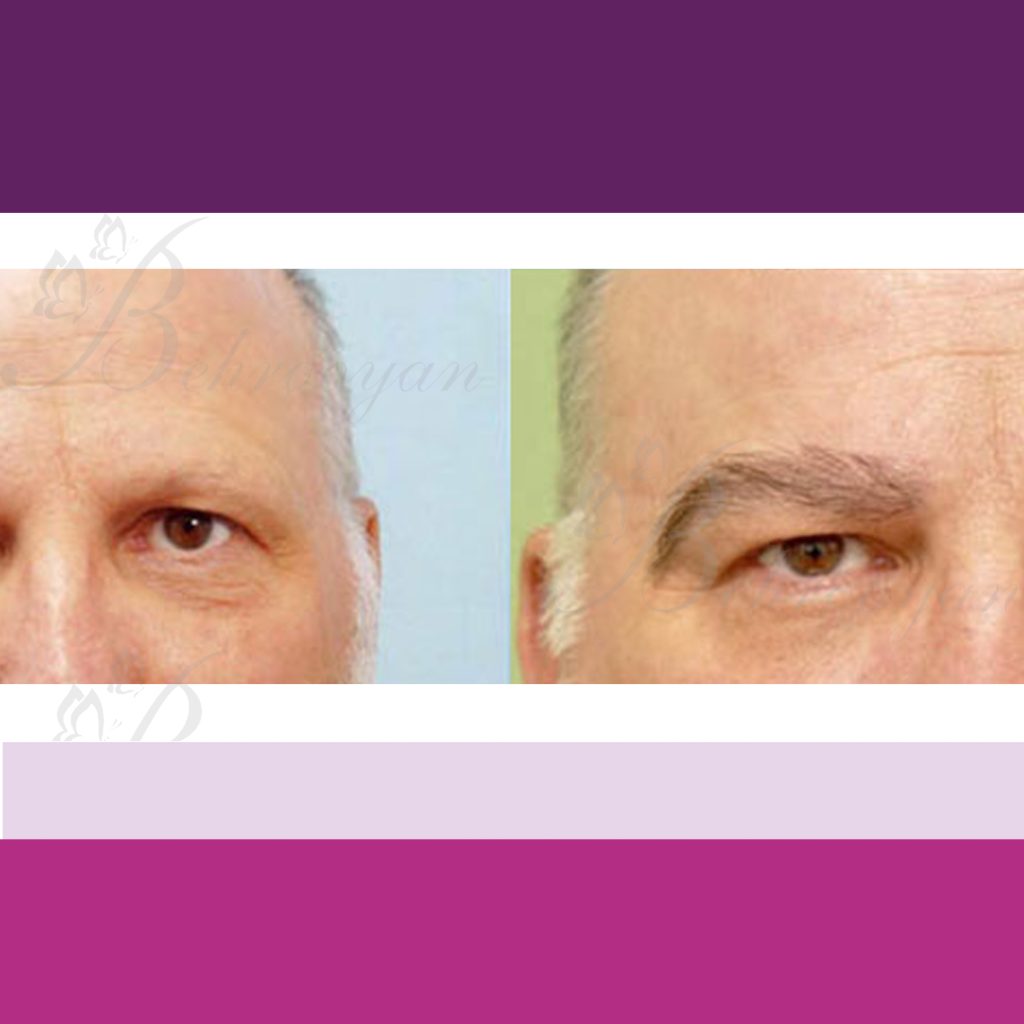 کاشت ابرو با موی طبیعی