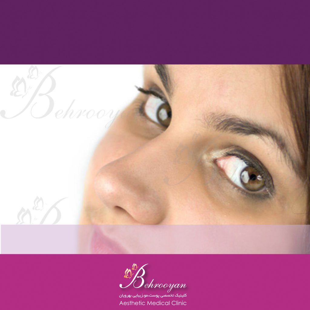 کربوکسی تراپی سیاهی زیر چشم