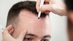 زراعة الشعر