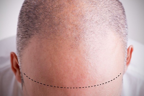 تعليمات قبل و بعد عملية زراعة الشعر | مرکز بهرویان الطبی للتجمیل