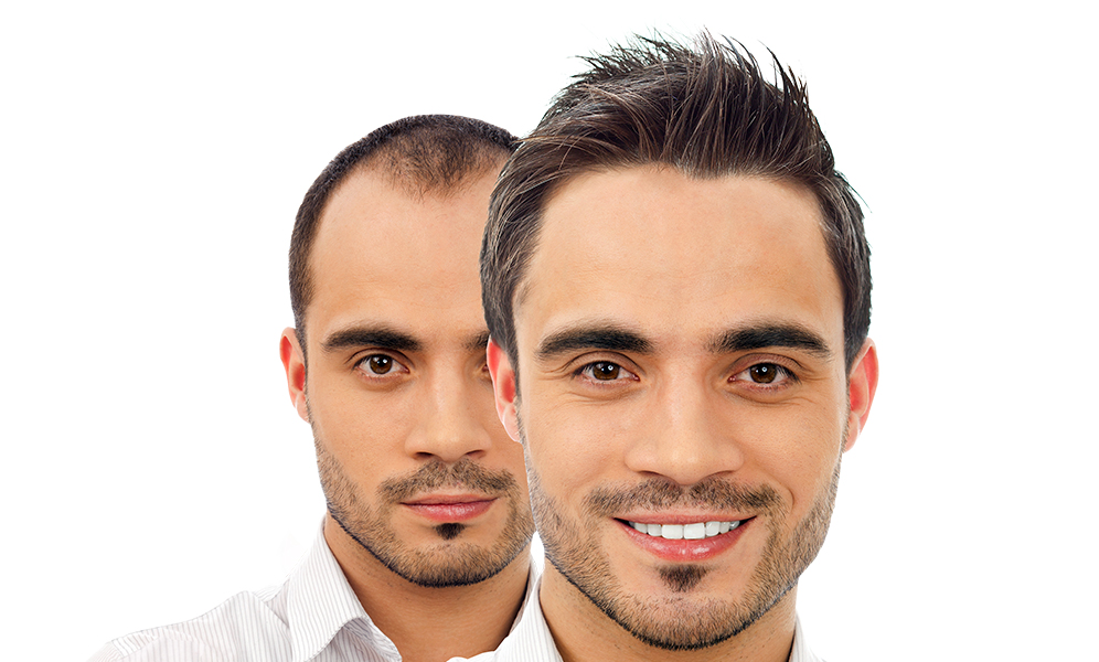 زراعة الشعر زراعة الشعر