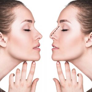 Rhinoplasty تجميل الأنف في ایران