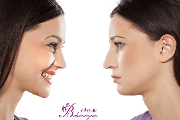 تجميل الأنف في ایران