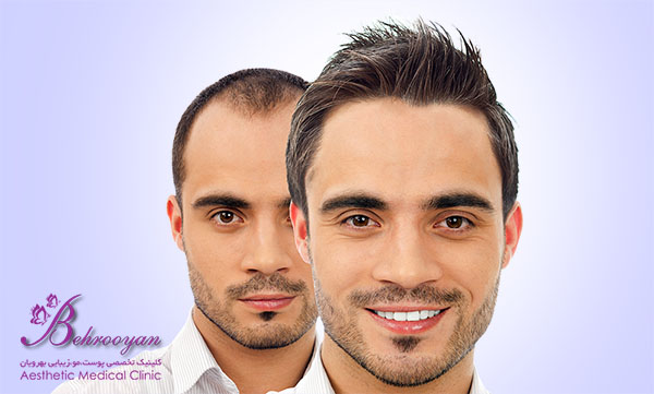 کاشت مو در کلینیک بهرویان