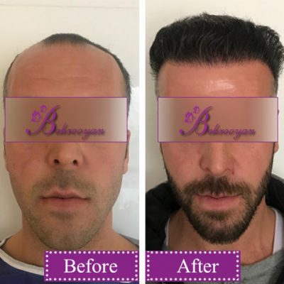 hair-transplantion10 کاشت مو در کلینیک بهرویان