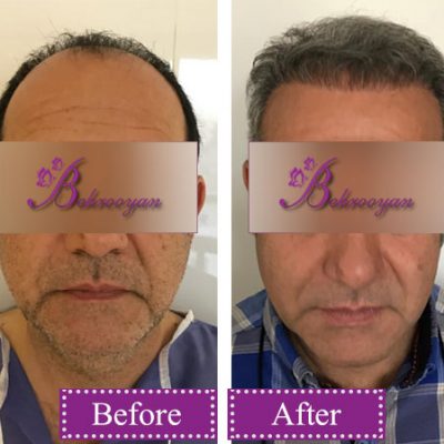 hair-transplantion7 کاشت مو در کلینیک زیبایی بهرویان