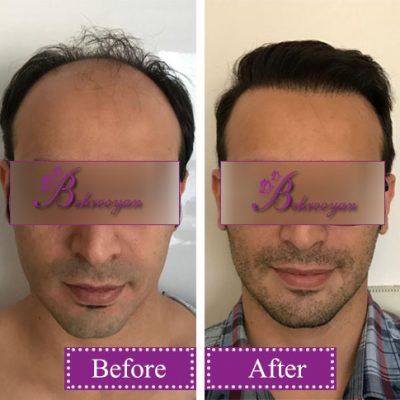 hair-transplantion8 کاشت مو در کلینیک زیبایی بهرویان