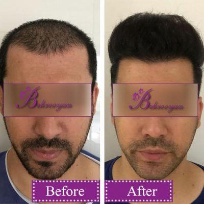 hair-transplantion9 کاشت مو در کلینیک بهرویان