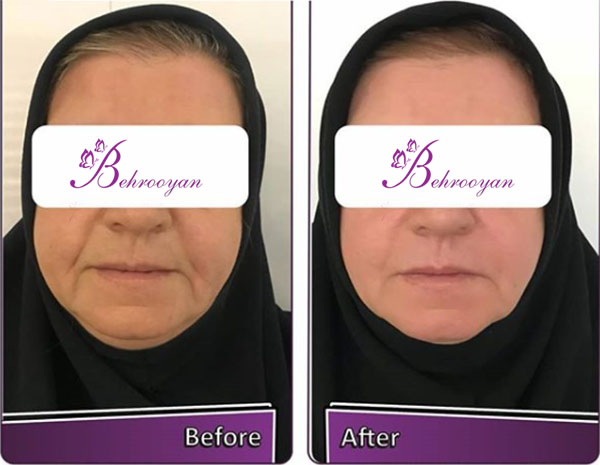 عکس قبل و بعد اندولیفت