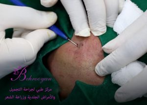 Subcision