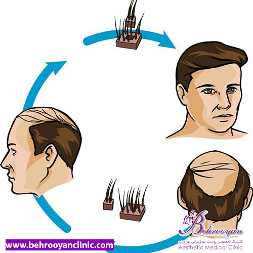 بهترین سن کاشت مو - کاشت مو به روش جراحی