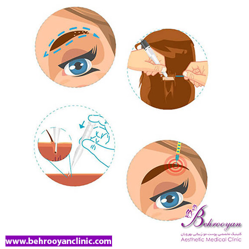 عوارض کاشت ابرو - کاشت ابرو چیست