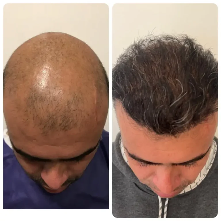 kasht moo before after (1)