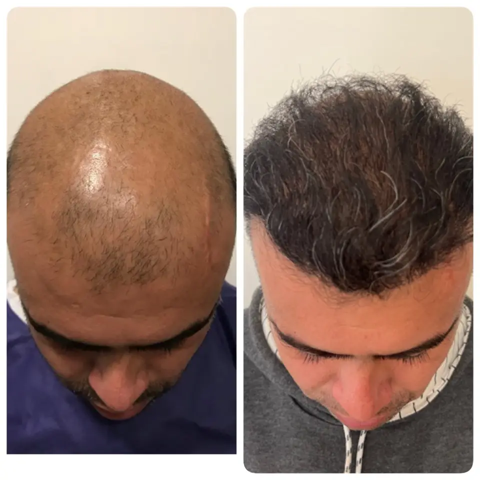 kasht moo before after (1)