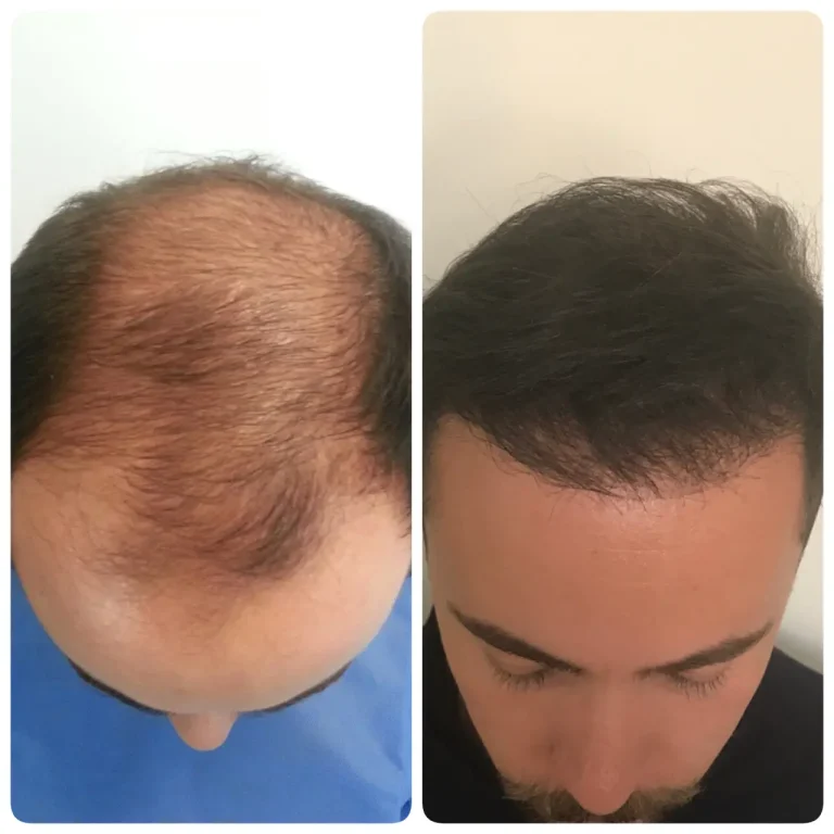 kasht moo before after (10)
