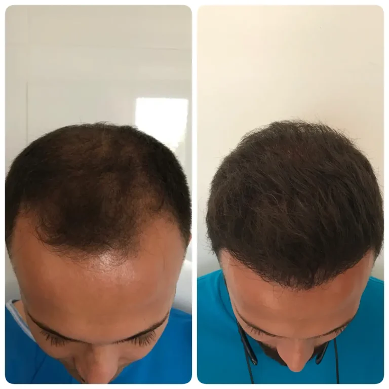 kasht moo before after (4)