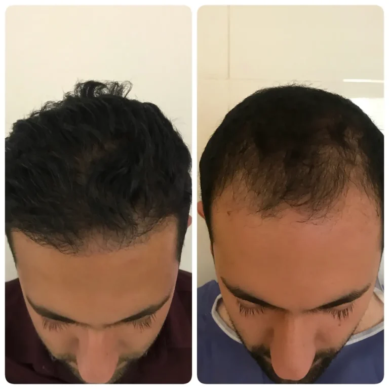 kasht moo before after (9)