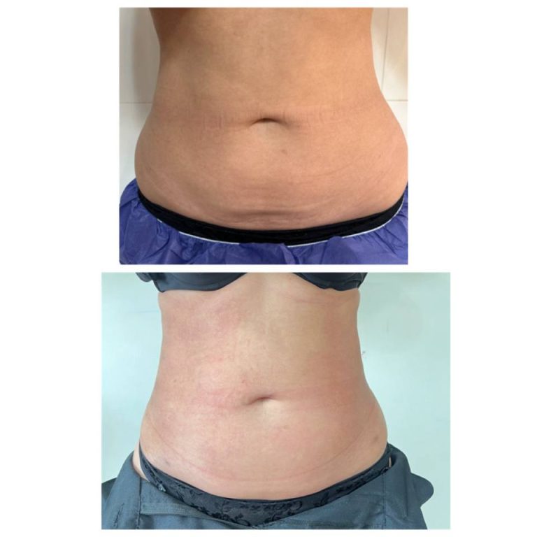 رنووین before after (3)