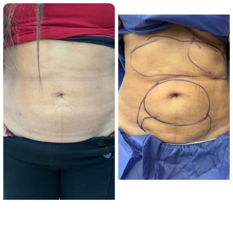 رنووین before after (4)