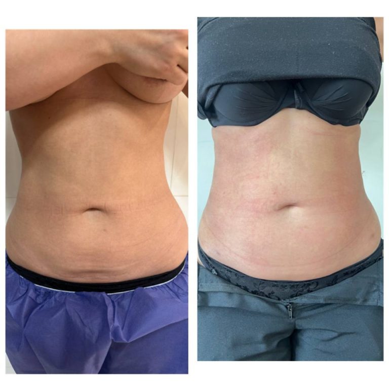 رنووین before after (5)