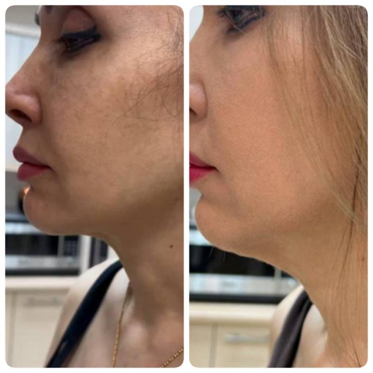 رنووین before after (6)