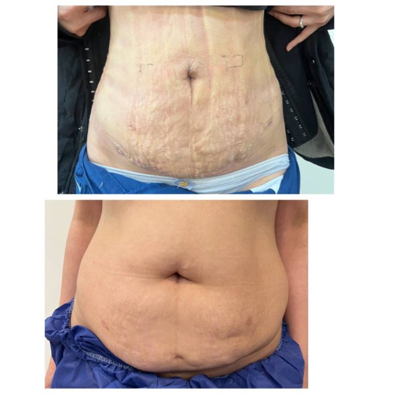 رنووین before after (7)