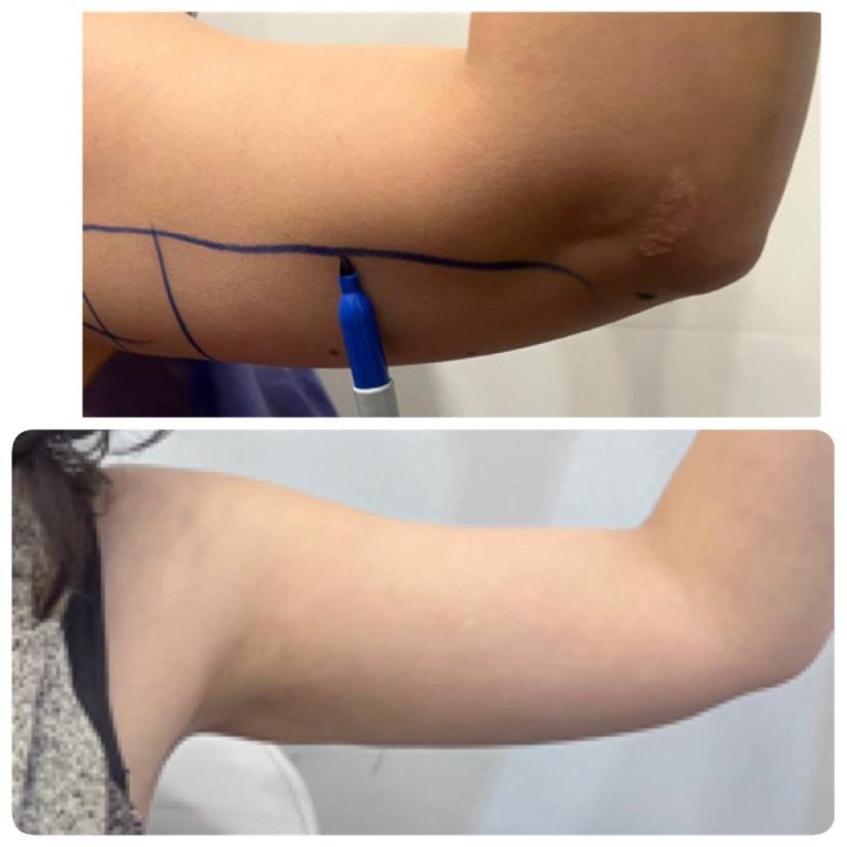 رنووین before after (8)
